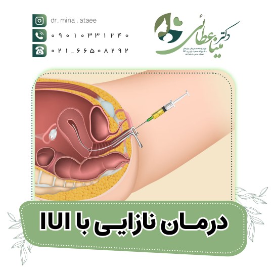 درمان نازایی با iui